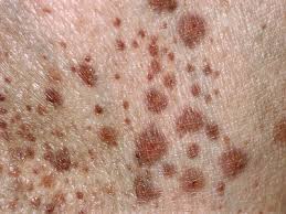 Events that cause an increase in pressure, such as coughing or vomiting can cause petechiae around the face or eyes. Medicine Diseases Ailments Skin Hair Nails Purpura Petechiae Stock Photos And Pictures Science Photo Library