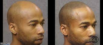 Hair tattoo cost can run from $2,000 to $3,500, according to matt iulo, a tattoo technician and founder of scalp micro usa. How Scalp Tattoos Are Empowering Men With Hair Loss Scalp Tattoo Hair Tattoos Hair Loss