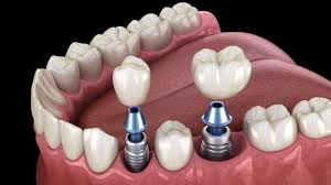Restore Your Smile With Confidence: The Complete Guide to Dental Implants  in Encino | Dental Implants Encino CA