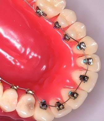 Lingual Braces product image