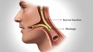 Image result for Eustachian Tube Dysfunction
