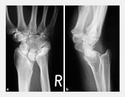 Https Www Handchirurgie Ravensburg De Fileadmin Benutzerdaten Handchirurgie Ravensburg De Pdf Publikationen Distale Radiuskorrekturosteotomie Indikation Therapeutisches Vorgehen Pdf