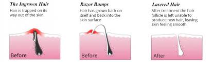 46 newman springs rd e. Laser Hair Removal Acne Scar Treatment Laser Hair Removal Permanent It S Time To Get Rid Of Ingrown Hair Permanently