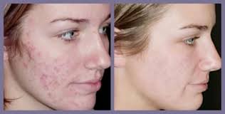 Pin On Chemical Peel