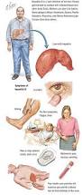 Image result for hepatitis symptoms