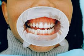 Image result for Gingivitis