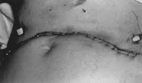 Cancer that spreads from where it started to a distant part of the body is called metastatic cancer. The Spread And Staging Of Cervical Cancer Glowm