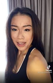 燒傷處理】少女滾油灼臉致3級燒傷勇敢面對傷疤活出精彩人生