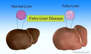 How Can One Cure A Fatty Liver Quora Uses of evion 400mg strip of 10 capsules. how can one cure a fatty liver quora