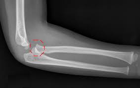 Image result for Elbow XRay