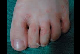 Infection at the sites pictured here may also be. Ringworm Tinea Corporis Faciei Picture Image On Emedicinehealth Com