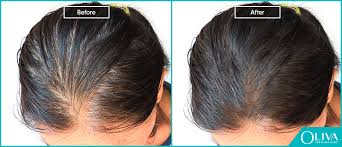 Fenugreek's high protein and nicotine fights against your hair fall, dryness, thinning, and dandruff. Thyroid Disorder Hair Loss How To Regrow Lost Hair