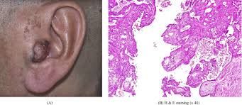Image result for Centrostigma papillosum