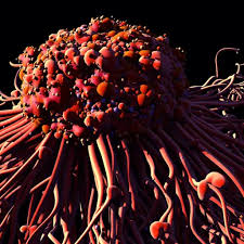 Skin cancers are cancers that arise from the skin. Metastatic Melanoma 7 Warning Signs Melanoma Has Spread