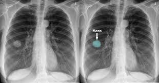 Image result for lung cancer xray