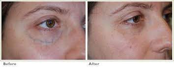 I had a blue vein under my eye for years. Blue Undereye Veins Treatment Berman Skin Institute