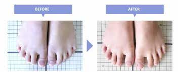 屈み指（かがみ指・ハンマートゥ）の症状と治療方法。ガッテン出演の足指博士が自宅で治せる足指ストレッチを紹介！ | ひろのば体操 オフィシャルサイト