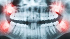 Jan 10, 2020 · wisdom teeth are the third set of molars in the back of your mouth. Should Your Teen S Wisdom Teeth Be Pulled Why Experts Disagree