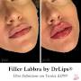 Filler Labbra Brescia - Dr Bertoli - AB LIPS from drlips.it