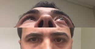 Image result for Proptosis