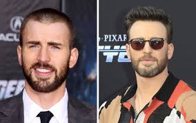 Chris Evans' Hair Transplant