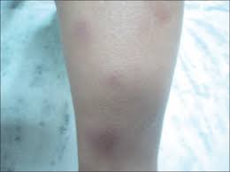 Image result for erythema nodosum