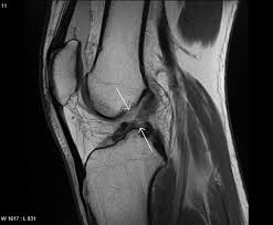 The anterior cruciate ligament (acl) and the posterior cruciate ligament (pcl) are inside the knee joint. Do You Need Knee Acl Surgery For A Partial Tear