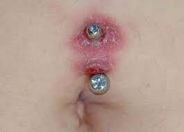 We did not find results for: Infected Belly Button Piercings Symptoms Treatment Authoritytattoo