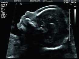 Ultrasound Is Indispensable In Prenatal Exams