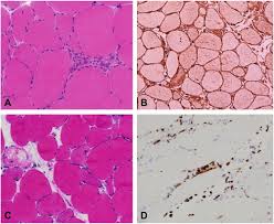 We did not find results for: Dermatomyositis Polymyositis And Immune Mediated Necrotising Myopathies Sciencedirect