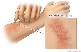 While most people do not experience a major allergic reaction, the effects of contact in nearly all cases of contact dermatitis, a rash will develop after exposure to an allergen or irritant. Contact Dermatitis New Mexico