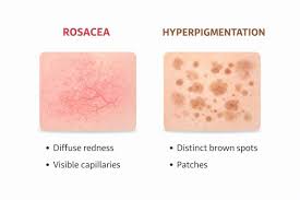Image result for Diffuse Hyperpigmentation