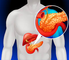 Pancreatic cancer (cancer of the pancreas) mainly occurs in people aged over 60. Chirurgie Pancreatique A Montpellier Chirurgie Du Pancreas