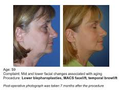 Blepharoplasty (eyelid) and Browlift Procedures » UF Health Plastic Surgery  and Aesthetics Center » UF Academic Health Center » University of Florida