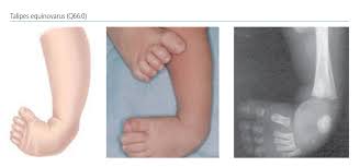 Know more about various deformities that could lead to painful or deformed foot. Chapter 4 9 Talipes Equinovarus Talipes Equinovarus Q66 0 Cdc