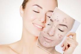 Cara menghilangkan bintik hitam di wajah. Ini Dia Cara Menghilangkan Bintik Bintik Hitam Bekas Jerawat Dara Co Id