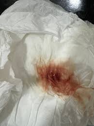 Pilula do dia seguinte | BabyCenter