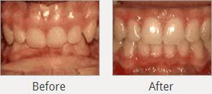 The most effective way to address an overbite is with orthodontic appliances like invisalign® or damon braces. Treatments Yuba City Ca Kids Smile Dental And Orthodontics