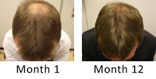 In this review, we are going to look at those treatments that are backed by evidence and discuss how they work so that you can make the best choice to treat your receding hairline. Hair Loss Of The Crown And Vertex Regrow Hair On A Thinning Crown