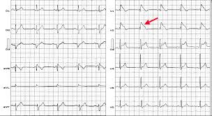 Osborn wave, camel hump sign of osborn, hypothermic hump, late delta wave, hathook junction, j wave, h wave, k wave. Http Cardiolatina Com Wp Content Uploads 2019 04 Andres Pdf