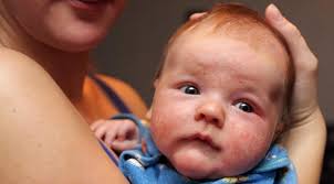 bebeklerde egzama belirtileri nelerdir egzama ne kadar surede gecer guncel yasam haberleri