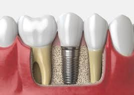 Dental implants are titanium posts that are inserted into your bone and act like the roots of your teeth. What You Should Pay For Dental Implants In Madison Dental Insurance Financing Accepted For Tooth Implant Dane County Discounted Denture Dentistry Middleton Alternatives Tooth Replacement Options Fitchburg Total