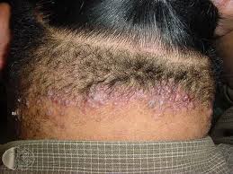 Collection by ingrown hair neck. Pin On Blindness