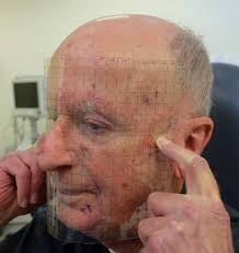 Response to “Transparent grid system as a novel tool to prevent wrong-site  skin surgery