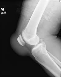 Image result for Prepatellar Bursa Injection