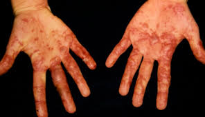 Image result for Erythema Multiforme Causes