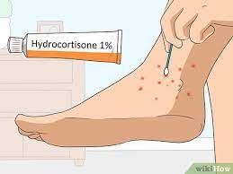 As soon as you notice the bites of chiggers, you need to go to the bathroom and get a hot shower. 3 Ways To Treat Chigger Bites Wikihow