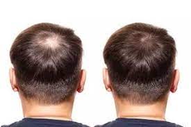Change in the color of your nails and hair loss can also indicate an iron deficiency. Pin On Is Iron Deficiency Cussing Your Hair Loss
