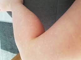 Weisse Hautflecken Kennt Die Jemand Korper Haut