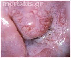 Image result for Colposcopy Findings